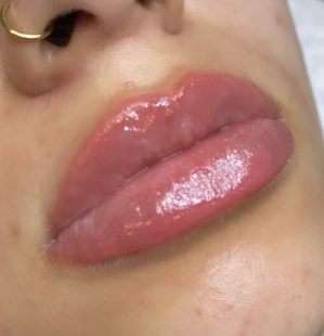 Lip Contouring